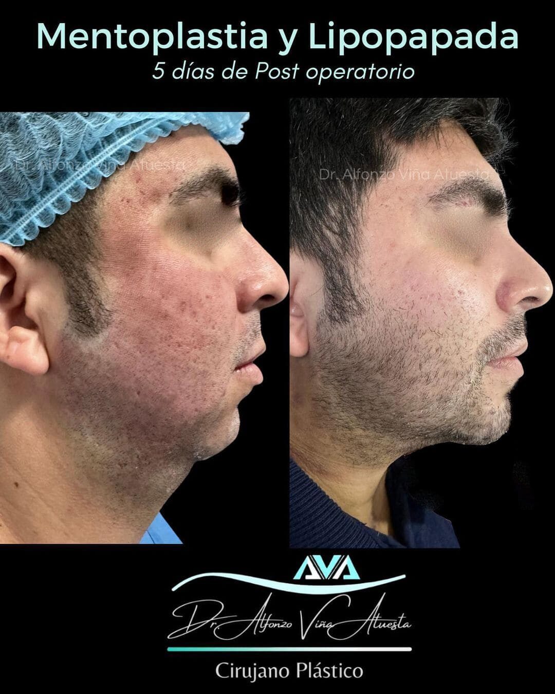 facial