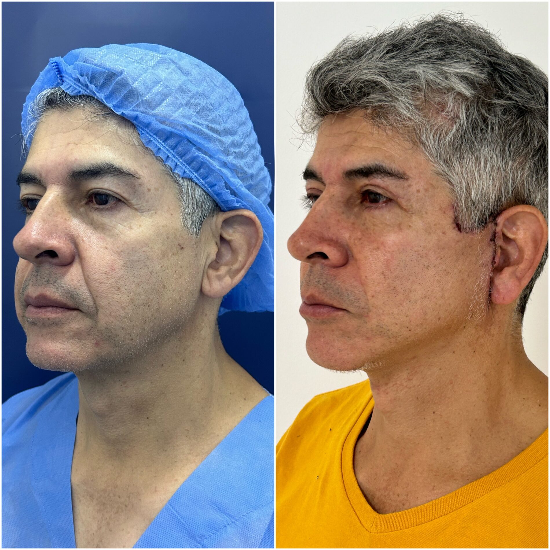 facial